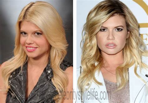 chanel west coast cosmetic surgery.